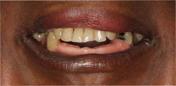 Before smile of a patient at Djawdan Center for Implant and Restorative Dentistry 