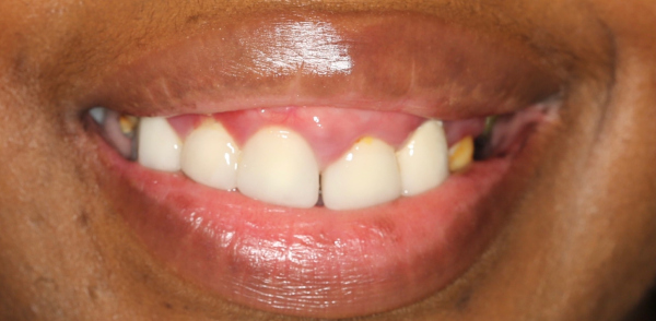 Before smile of a patient at Djawdan Center for Implant and Restorative Dentistry 