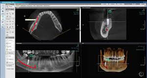 3D Implant Planning at Djawdan Center for Implant and Restorative Dentistry