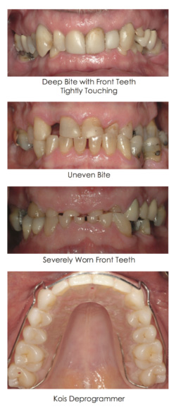 first bite dental