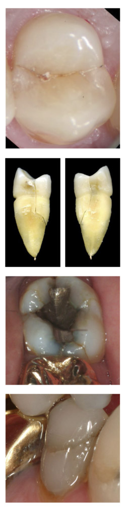 Cracked tooth case displayed in the set of images at Djawdan Center for Implant and Restorative Dentistry.