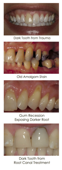 Discolored tooth case displayed in the set of images at Djawdan Center for Implant and Restorative Dentistry.