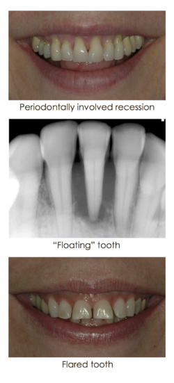 Loose tooth case in the form of three images at Djawdan Center for Implant and Restorative Dentistry 
