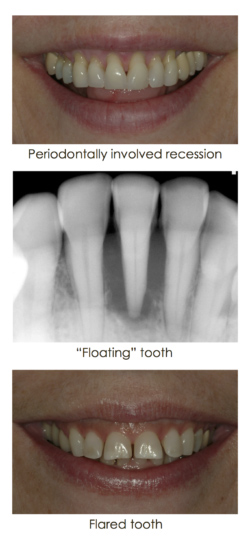 Causes Of A Loose Tooth