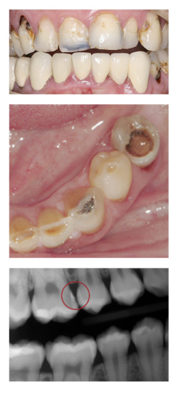 Jaw and Gum Resorption, Annapolis Specialist for Restoring Your Oral  Health