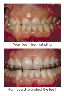 Teeth Grinding before and after case picture at Djawdan Center for Implant and Restorative Dentistry.