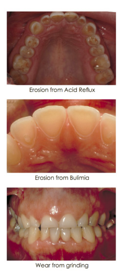 Tooth wear in the interior of the lower gum - case study images at Djawdan Center for Implant and Restorative Dentistry 
