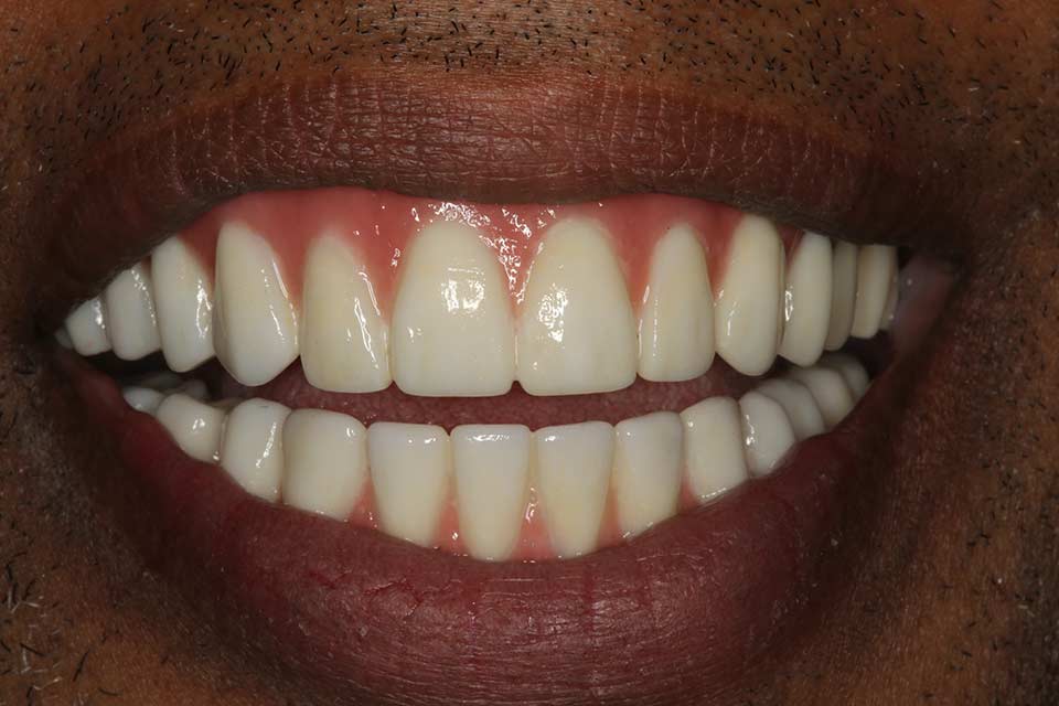 After smile of a patient at Djawdan Center for Implant and Restorative Dentistry 