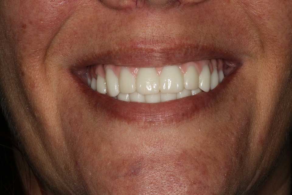 After smile of a patient at Djawdan Center for Implant and Restorative Dentistry 
