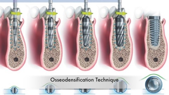 Diagram of Osseodensification Technique for Dental Implants