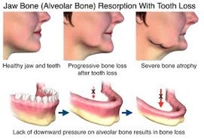 Diagram of jaw resorption examples at Djawdan Center for Implant and Restorative Dentistry.