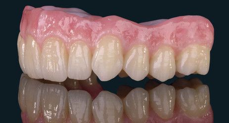 Image of upper denture from the on-site lab at Djawdan Center for Implant and Restorative Dentistry in Annapolis, MD