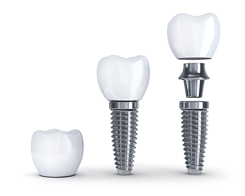 Image of dental implant screws at Djawdan Center for Implant and Restorative Dentistry in Annapolis.