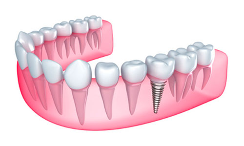 Is Caring for Dental Implants Any Different Than Original Teeth?