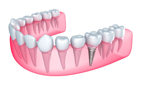 How Long Do Dental Implants Last?