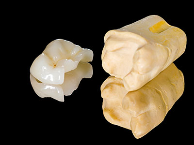 Inside of a tooth shown after the applications of an inlay.