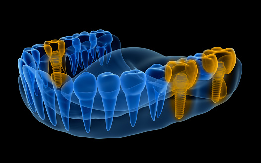 Diagram of jaw with several dental implant restorations for cost estimation.