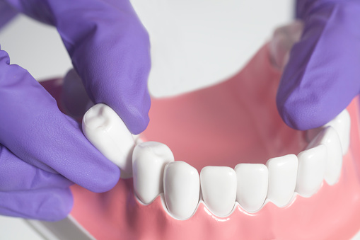 Wisdom Teeth Management and Extraction