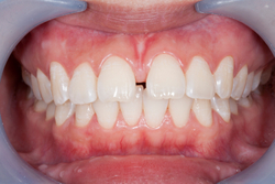 Close-up of a patient's teeth with a gap at Djawdan Center for Implant and Restorative Dentistry