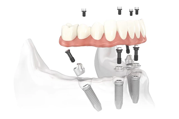 Diagram of All-on-4 Treatment Concept implant bridge placed in the jaw.