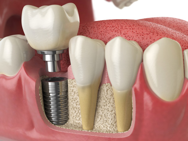 Diagram of dental implant into jaw bone at Djawdan Center for Implant and Restorative Dentistry in Annapolis.