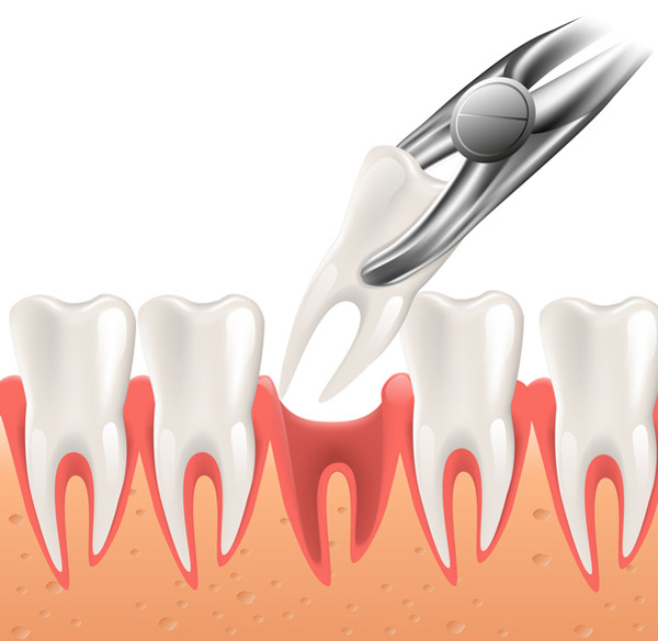 3D rendering of a tooth extraction at Djawdan Center for Implant and Restorative Dentistry in Annapolis, MD