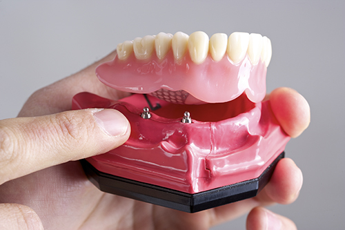 hands holding a 3d model of implant supported dentures