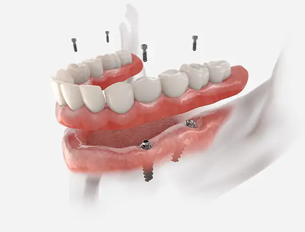 Upper and lower arch All-on-4 dental implants being positioned for a full-mouth restoration.