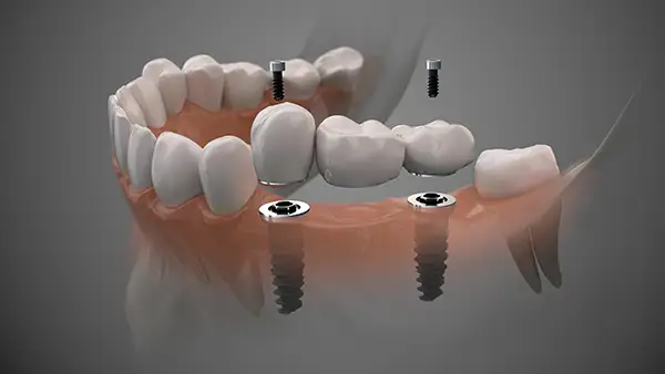 A revealing close-up of a dental implant bridge supported by two screws, highlighting modern tooth replacement solutions.