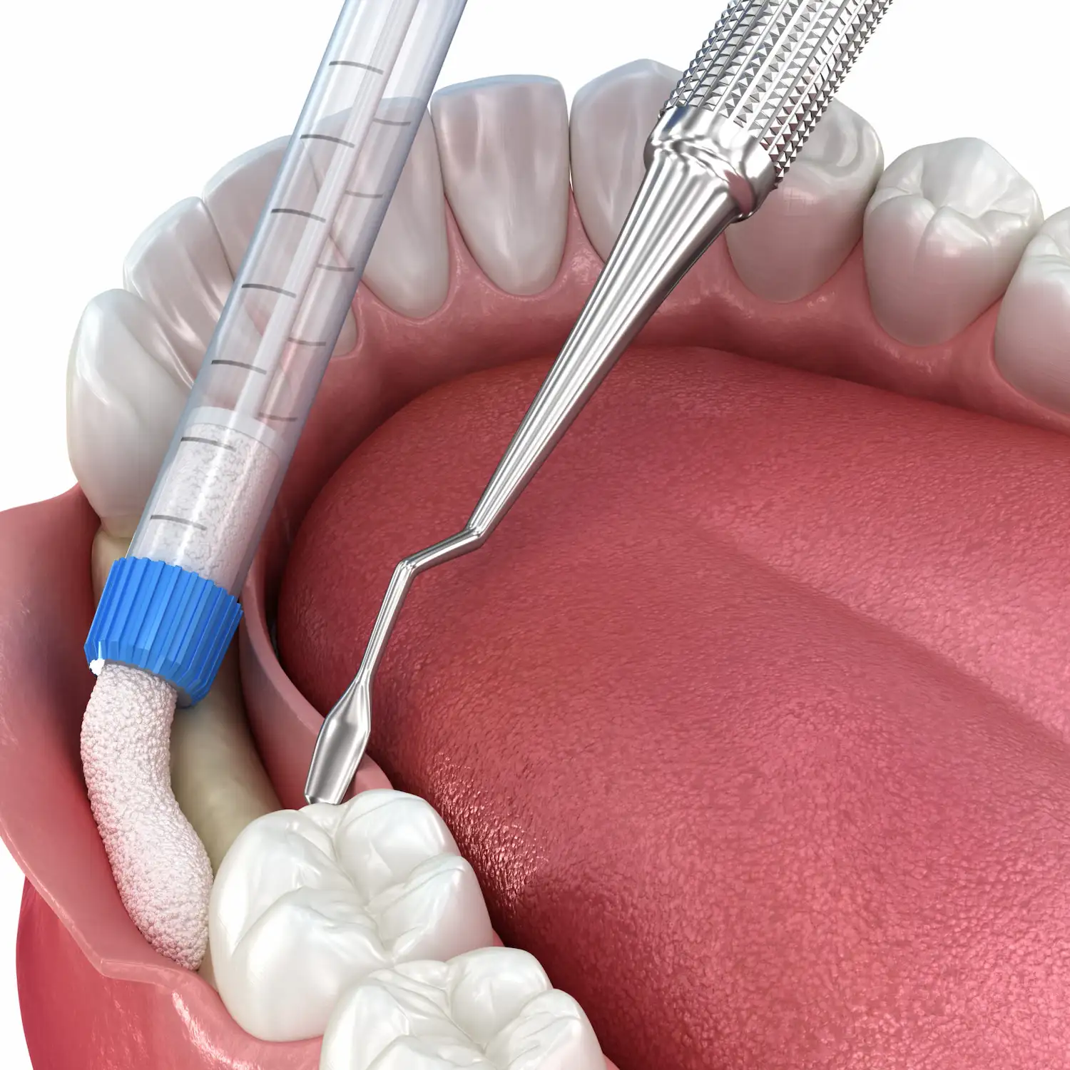 Bone-Grafting